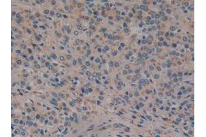 DAB staining on IHC-P; Samples: Human Prostate cancer Tissue (GP2 抗体  (AA 307-512))