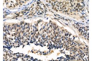 ABIN6264490 and ABIN6276475 at 1/100 staining Human ovarian cancer by IHC-P.