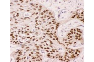 IHC-P: p63 antibody testing of human oesophagus squama cancer tissue (TCP1 alpha/CCTA 抗体  (AA 311-680))