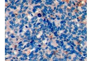 Detection of PD1 in Human Ovarian cancer Tissue using Monoclonal Antibody to Programmed Cell Death Protein 1 (PD1) (PD-1 抗体  (AA 41-132))