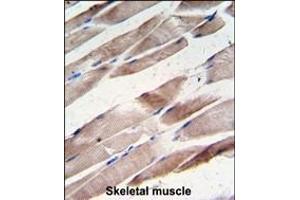 Formalin-fixed and paraffin-embedded human hepatocarcinoma tissue reacted with the primary antibody, which was peroxidase-conjugated to the secondary antibody, followed by DAB staining. (Desmin 抗体  (AA 1-30))