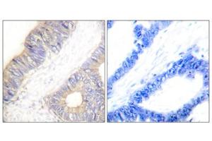 Immunohistochemistry analysis of paraffin-embedded human colon carcinoma tissue using Stefin A antibody. (CSTA 抗体  (Internal Region))
