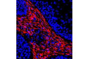 Immunofluorescence of paraffin embedded human laryngocarcinoma using CRMP3 (ABIN7073734) at dilution of 1:650 (400x lens) (DPYSL4 抗体)