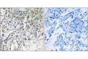 Immunohistochemistry analysis of paraffin-embedded human breast carcinoma tissue, using ELL2 Antibody. (ELL2 抗体  (AA 448-497))