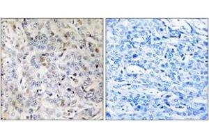 Immunohistochemistry analysis of paraffin-embedded human breast carcinoma tissue, using PDIK1L Antibody. (PDIK1L 抗体  (AA 101-150))