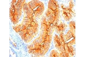 Immunohistochemical staining (Formalin-fixed paraffin-embedded sections) of human colon cancer with tag-72 monoclonal antibody, clone SPM148 . (TAG-72 抗体)