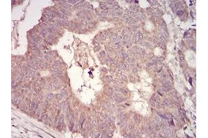 Immunohistochemical analysis of paraffin-embedded rectum cancer tissues using MuRF1 mouse mAb with DAB staining. (TRIM63 抗体  (AA 293-304))