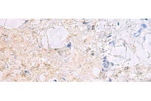Immunohistochemistry of paraffin-embedded Human gastric cancer tissue using DPCD Polyclonal Antibody at dilution of 1:50(x200) (DPCD 抗体)