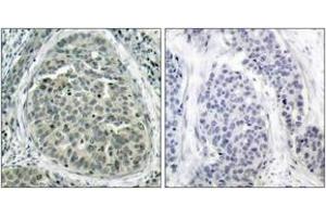 Immunohistochemistry analysis of paraffin-embedded human breast carcinoma, using Catenin-beta (Phospho-Ser37) Antibody. (beta Catenin 抗体  (pSer37))