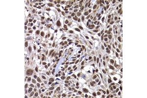 Immunohistochemistry of paraffin-embedded human well-differentiated squamous skin carcinoma using DNAJB6 antibody at dilution of 1:100 (x400 lens). (DNAJB6 抗体)