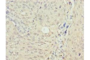 Immunohistochemistry of paraffin-embedded human lung cancer using ABIN7160268 at dilution of 1: 100 (RAE1 抗体  (AA 1-368))