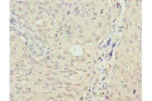 Immunohistochemistry of paraffin-embedded human lung cancer using ABIN7160268 at dilution of 1: 100 (RAE1 抗体  (AA 1-368))