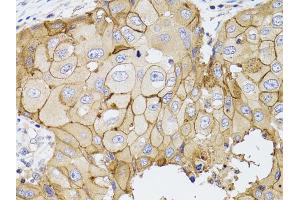 Immunohistochemistry of paraffin-embedded human breast cancer using PDE4D antibody (ABIN5970821) at dilution of 1/100 (40x lens). (PDE4D 抗体)