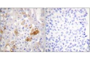 Immunohistochemistry analysis of paraffin-embedded human breast carcinoma, using Integrin beta1 (Phospho-Thr788) Antibody. (ITGB1 抗体  (pThr788))
