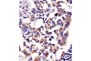 (ABIN6242390 and ABIN6578681) staining Hsp60 in human lung adenocarcinoma tissue sections by Immunohistochemistry (IHC-P - paraformaldehyde-fixed, paraffin-embedded sections).