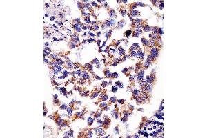(ABIN6242390 and ABIN6578681) staining Hsp60 in human lung adenocarcinoma tissue sections by Immunohistochemistry (IHC-P - paraformaldehyde-fixed, paraffin-embedded sections). (HSPD1 抗体  (AA 396-430))