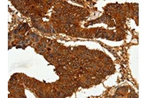 The image on the left is immunohistochemistry of paraffin-embedded Human colon cancer tissue using ABIN7128894(CEACAM21 Antibody) at dilution 1/60, on the right is treated with fusion protein. (CEACAM21 抗体)