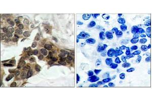 Immunohistochemical analysis of paraffin-embedded human breast carcinoma tissue, using IκB-α (phospho-Ser32/Ser36) antibody (E011152) . (NFKBIA 抗体  (pSer32, pSer36))