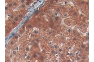 Detection of PYGL in Human Liver cancer Tissue using Polyclonal Antibody to Glycogen Phosphorylase, Liver (PYGL) (PYGL 抗体  (AA 370-538))