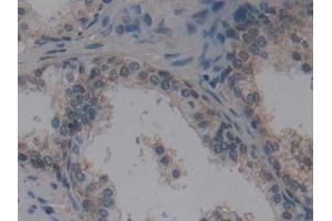Detection of VIL in Human Prostate Tissue using Polyclonal Antibody to Villin (VIL) (Villin 1 抗体  (AA 1-320))