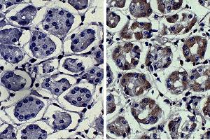 Paraffin embedded human kidney cancer tissue was stained with Mouse IgG2a-UNLB isotype control, DAB, and hematoxylin. (MMP3 抗体)