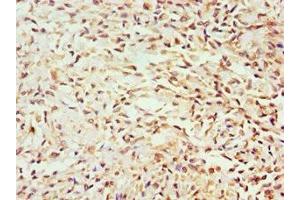 Immunohistochemistry of paraffin-embedded human breast cancer using ABIN7154587 at dilution of 1:100 (GEM 抗体  (AA 1-150))