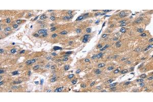 Immunohistochemistry of paraffin-embedded Human liver cancer tissue using SRGN Polyclonal Antibody at dilution 1:25 (SRGN 抗体)