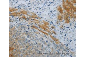 Immunohistochemistry of Human liver cancer using NPHS1 Polyclonal Antibody at dilution of 1:40 (Nephrin 抗体)