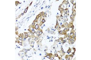 Immunohistochemistry of paraffin-embedded human colon carcinoma using PPOX antibody. (PPOX 抗体)