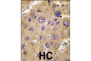 Formalin-fixed and paraffin-embedded human hepatocellular carcinoma reacted with ALDH6A1 polyclonal antibody  , which was peroxidase-conjugated to the secondary antibody, followed by DAB staining. (ALDH6A1 抗体  (C-Term))
