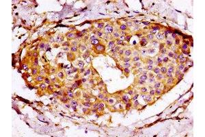 IHC image of ABIN7142571 diluted at 1:100 and staining in paraffin-embedded human breast cancer performed on a Leica BondTM system. (RPS7 抗体  (AA 1-194))