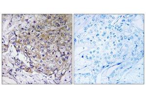 Immunohistochemistry analysis of paraffin-embedded human breast carcinoma tissue, using WASF3antibody. (WASF3 抗体  (Internal Region))