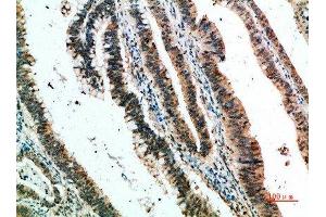 Immunohistochemical analysis of paraffin-embedded human-colon-cancer, antibody was diluted at 1:200 (CLEC4A 抗体  (AA 161-210))