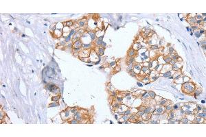 Immunohistochemistry of paraffin-embedded Human breast cancer using PTP4A2 Polyclonal Antibody at dilution of 1:30 (PTP4A2 抗体)