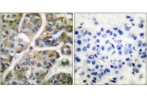 Immunohistochemistry analysis of paraffin-embedded human breast carcinoma tissue, using Granzyme B Antibody. (GZMB 抗体  (AA 10-59))