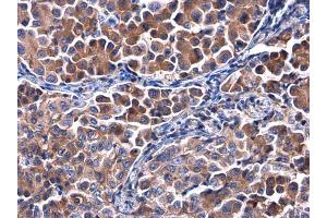 IHC-P Image Calpastatin antibody detects Calpastatin protein at cytoplasm in human lung cancer by immunohistochemical analysis. (Calpastatin 抗体)