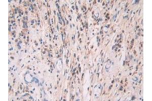 Detection of FBLN1 in Human Stomach cancer Tissue using Polyclonal Antibody to Fibulin 1 (FBLN1)