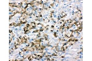 IHC-P: ALDH3A1 antibody testing of human gastric cancer tissue (ALDH3A1 抗体  (C-Term))