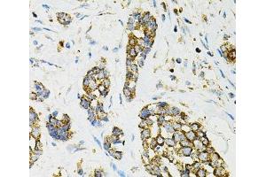 Immunohistochemistry of paraffin-embedded Human esophageal cancer using ADSS Polyclonal Antibody at dilution of 1:100 (40x lens). (ADSS 抗体)