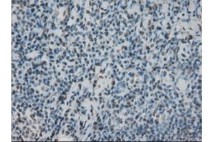 Immunohistochemical staining of paraffin-embedded lymphoma tissue using anti-PRKYmouse monoclonal antibody. (PRKY 抗体)