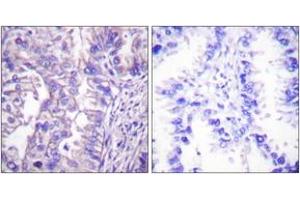 Immunohistochemistry analysis of paraffin-embedded human lung carcinoma tissue, using GAD1/2 Antibody. (GAD65+GAD67 (AA 545-594) 抗体)