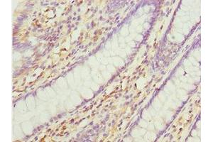 Immunohistochemistry of paraffin-embedded human colon cancer using ABIN7165175 at dilution of 1:100 (TNRC5 抗体  (AA 31-278))
