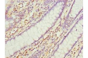 Immunohistochemistry of paraffin-embedded human colon cancer using ABIN7165175 at dilution of 1:100