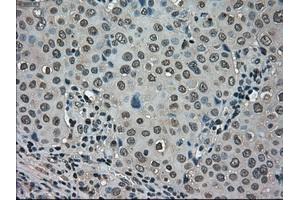 Immunohistochemical staining of paraffin-embedded Carcinoma of kidney tissue using anti-LDHAmouse monoclonal antibody. (Lactate Dehydrogenase A 抗体)
