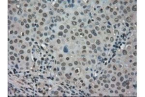 Immunohistochemical staining of paraffin-embedded Carcinoma of kidney tissue using anti-LDHAmouse monoclonal antibody. (Lactate Dehydrogenase A 抗体)