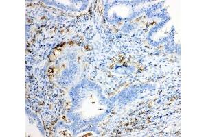 IHC-P: TRPC6 antibody testing of human intestinal cancer tissue