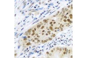 Immunohistochemical analysis of Cullin 4A staining in human colon cancer formalin fixed paraffin embedded tissue section. (Cullin 4A 抗体)