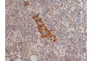 ABIN6267311 at 1/200 staining human breast cancer tissue sections by IHC-P. (KRT8 抗体  (pSer432))