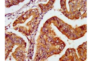 IHC image of ABIN7166879 diluted at 1:600 and staining in paraffin-embedded human endometrial cancer performed on a Leica BondTM system. (PNPO 抗体  (AA 114-207))