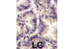 Formalin-fixed and paraffin-embedded human lung carcinoma tissue reacted with VEGFC polyclonal antibody  , which was peroxidase-conjugated to the secondary antibody, followed by DAB staining. (VEGFC 抗体  (Internal Region))